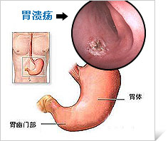 胃溃疡的症状和治疗方法